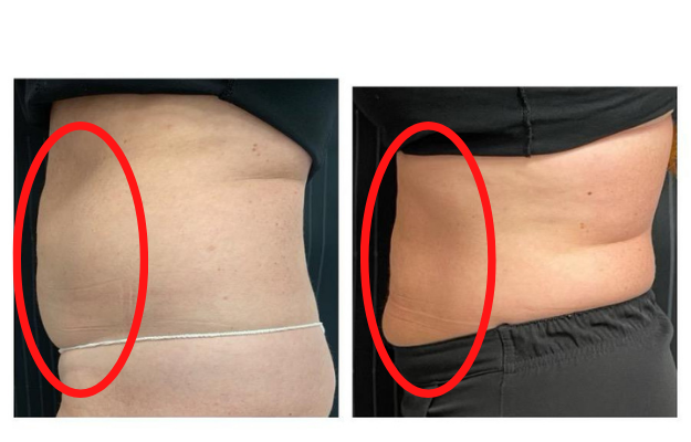 Body Contouring With PhysiQ  Advanced Aesthetics in Overland Park