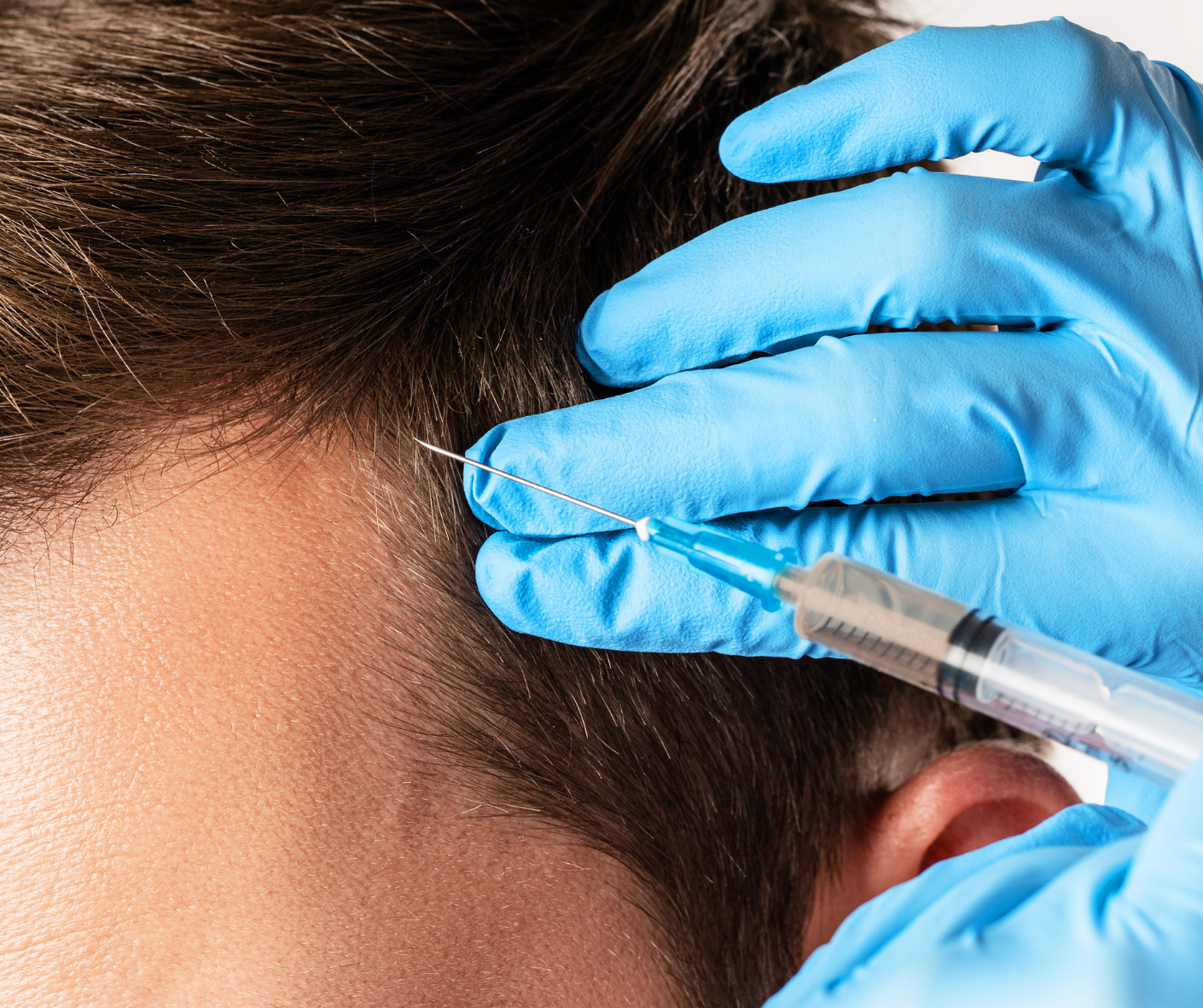 prp for hair restoration in men and women