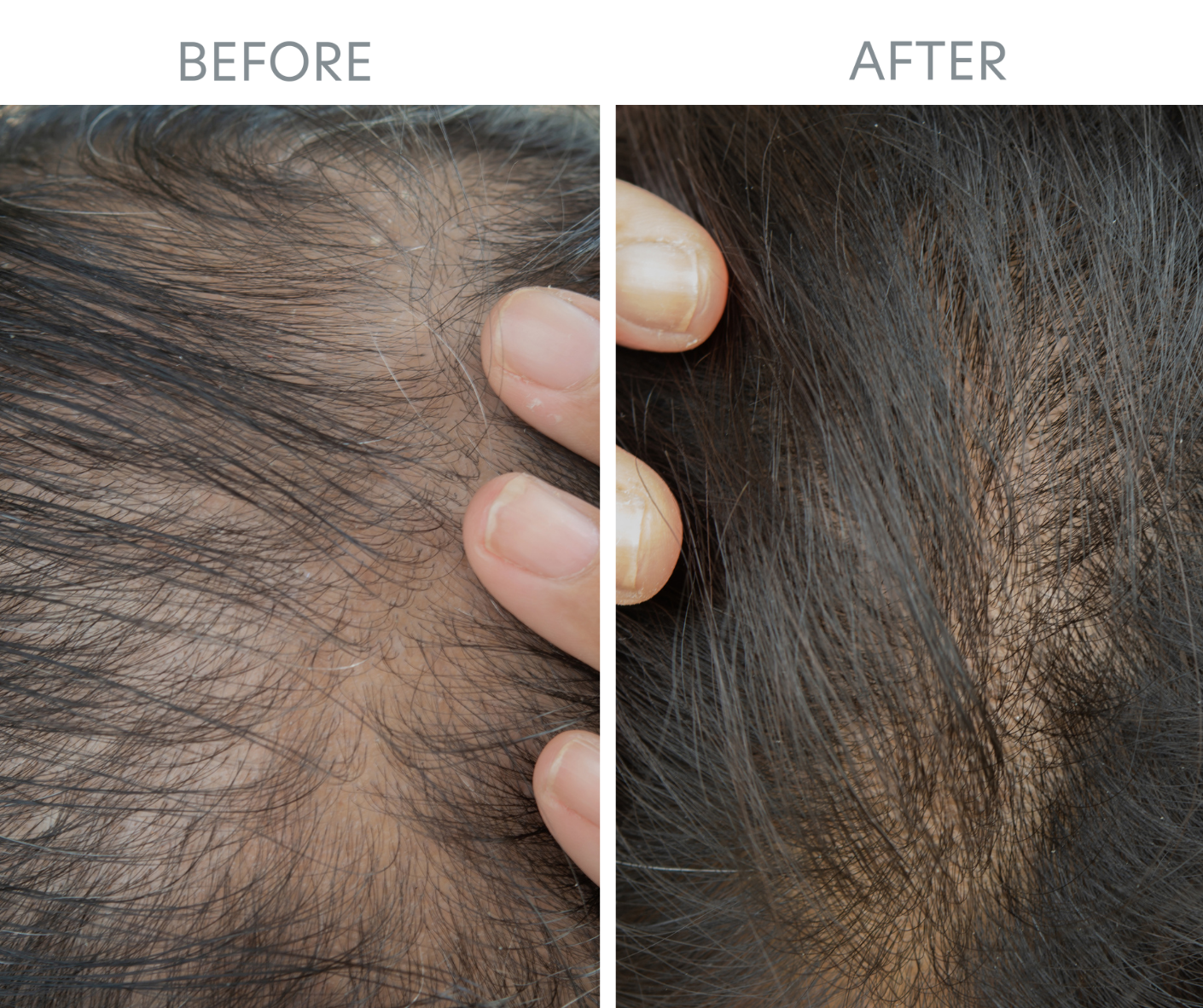 hair restoration before and after in men