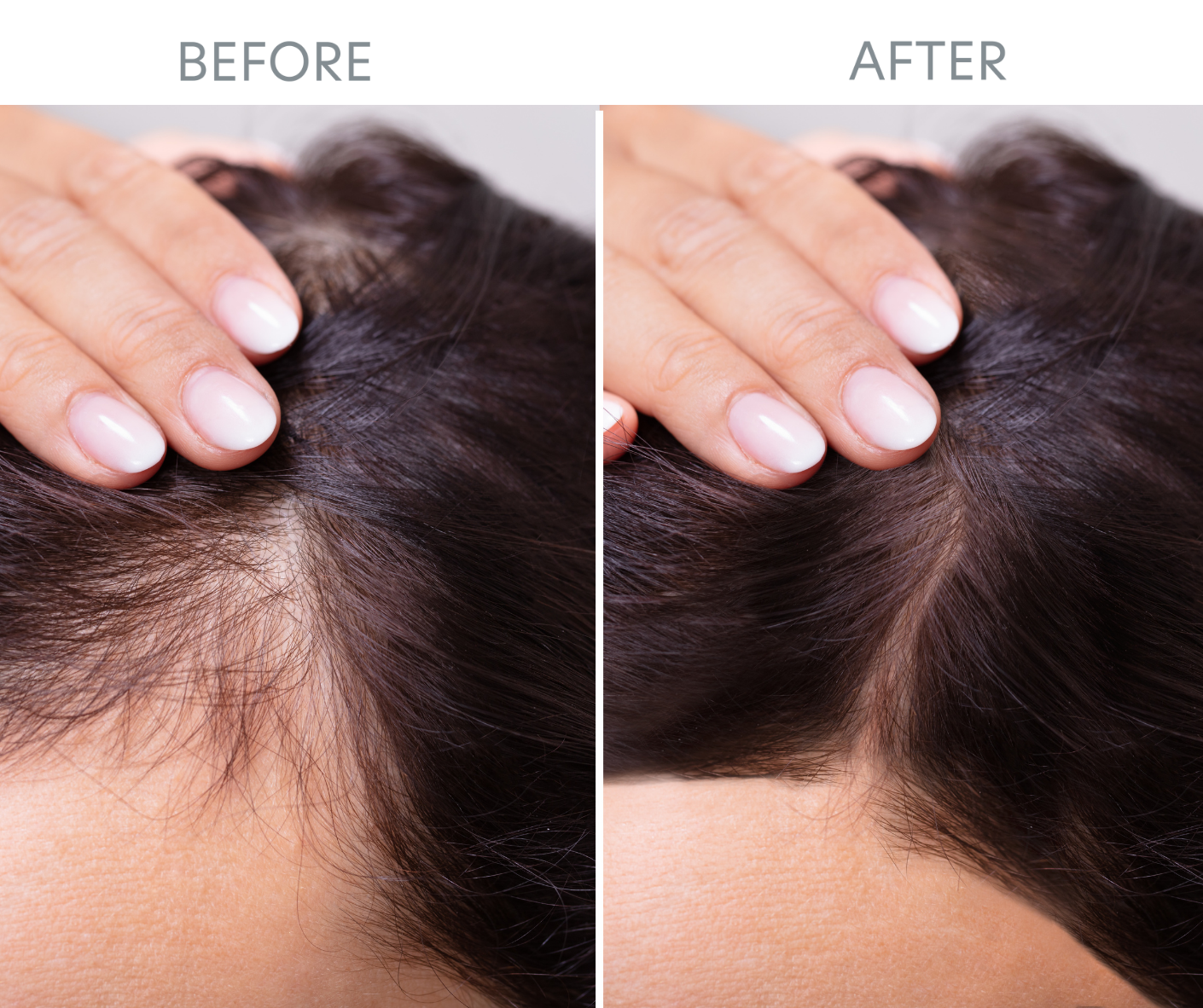 hair restoration before and after in women