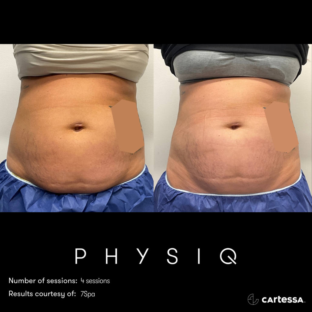 Exclusive Before After Physiq Body Treatments Nashville