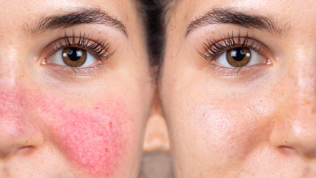 how to get rid of rosacea veins on face