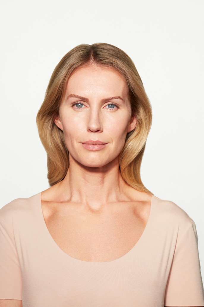 Chloe Sculptra Cheek 6 Mo After Facing Forward